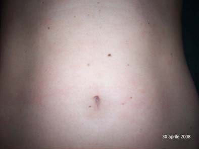pytiriasis